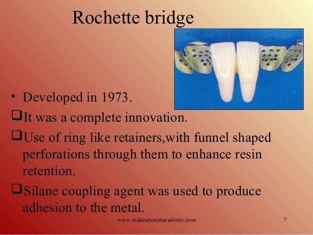of salt structure bridge bonded bridges.modi/ Labial orthodontics Resin of salt structure bridge bonded bridges.modi/ Labial orthodontics Resin