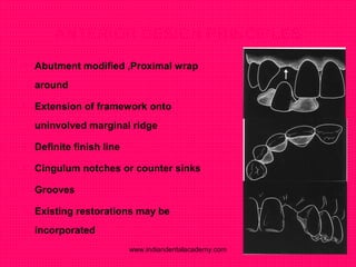 ANTERIOR DESIGN PRINCIPLES
 Abutment modified ,Proximal wrap
around
 Extension of framework onto
uninvolved marginal ridge
 Definite finish line
 Cingulum notches or counter sinks
 Grooves
 Existing restorations may be
incorporated
www.indiandentalacademy.com
 
