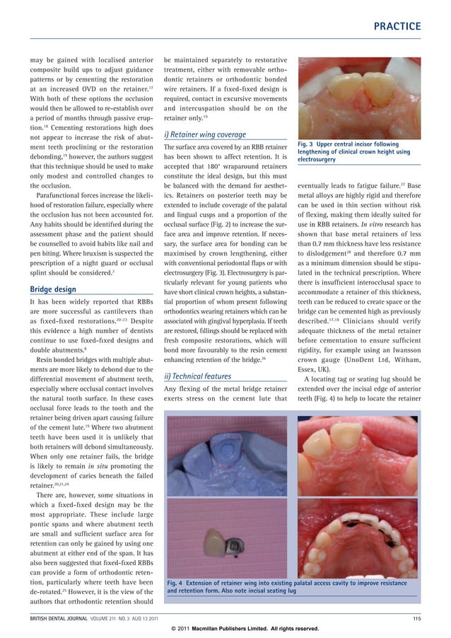Resin bonded bridges PDF