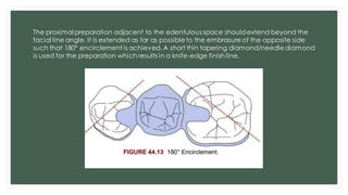 Resin Bonded fpd.pdf