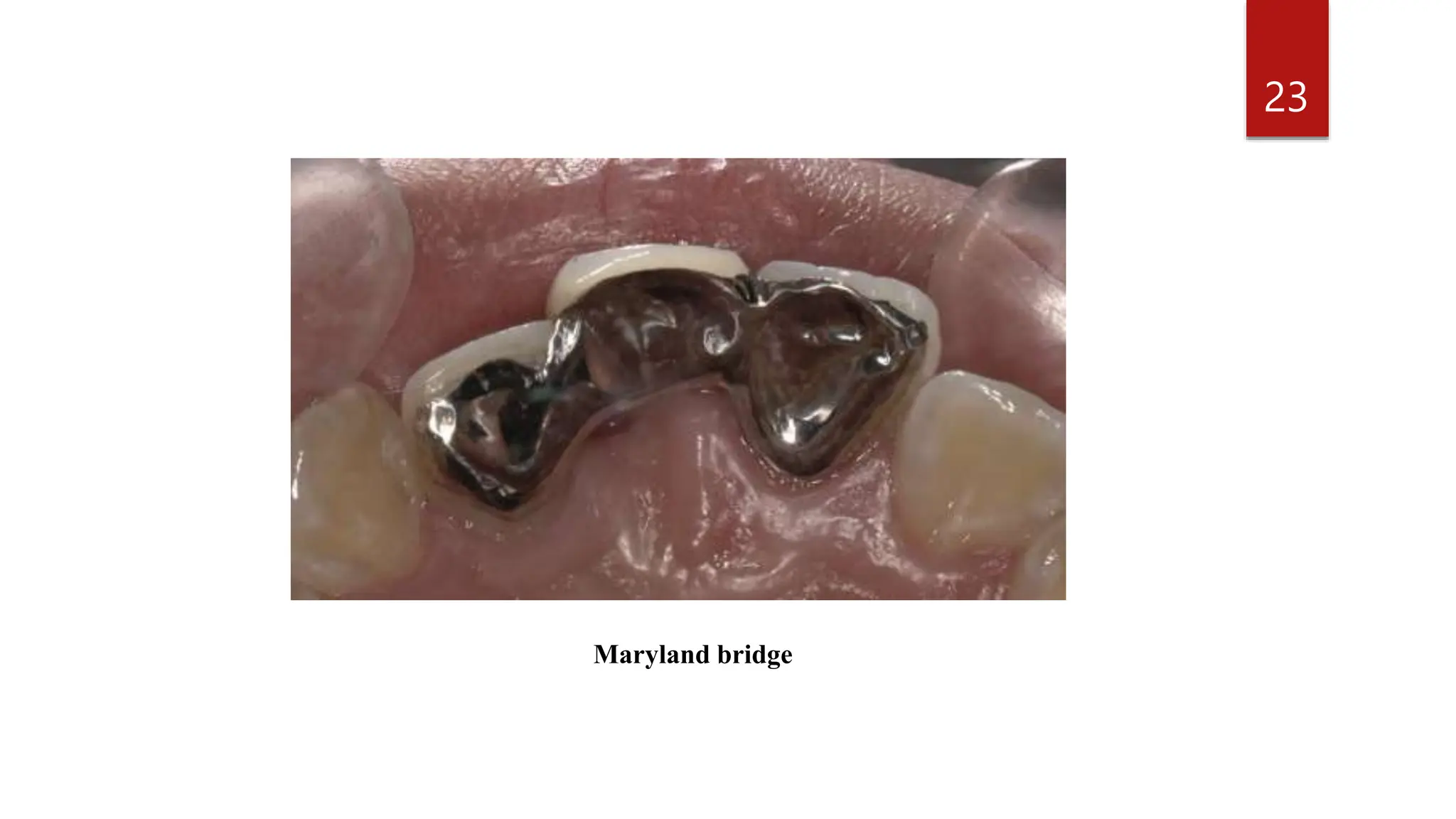 Resin bonded fixed partial denture. (RBFPD'S) | PPTX