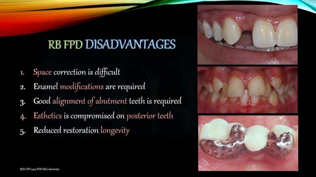Anterior Resin bonded FPD | PPT