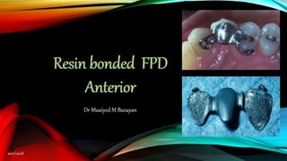 Anterior Resin bonded FPD  
