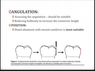 0ANGULATION:
0 Assessing the angulation – should be suitable
0 Reducing bulbosity to increase the connector height
0 POSITION:
0 Distal abutment with mesial cantilever is most suitable
 