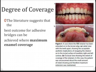 Degree of Coverage:
0The literature suggests that
the
best outcome for adhesive
bridges can be
achieved where maximum
enamel coverage
 