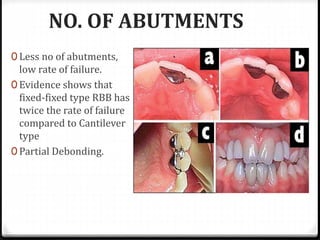 NO. OF ABUTMENTS
0 Less no of abutments,
low rate of failure.
0 Evidence shows that
fixed-fixed type RBB has
twice the rate of failure
compared to Cantilever
type
0 Partial Debonding.
 