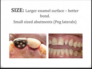 SIZE: Larger enamel surface – better
bond.
Small sized abutments (Peg laterals)
 