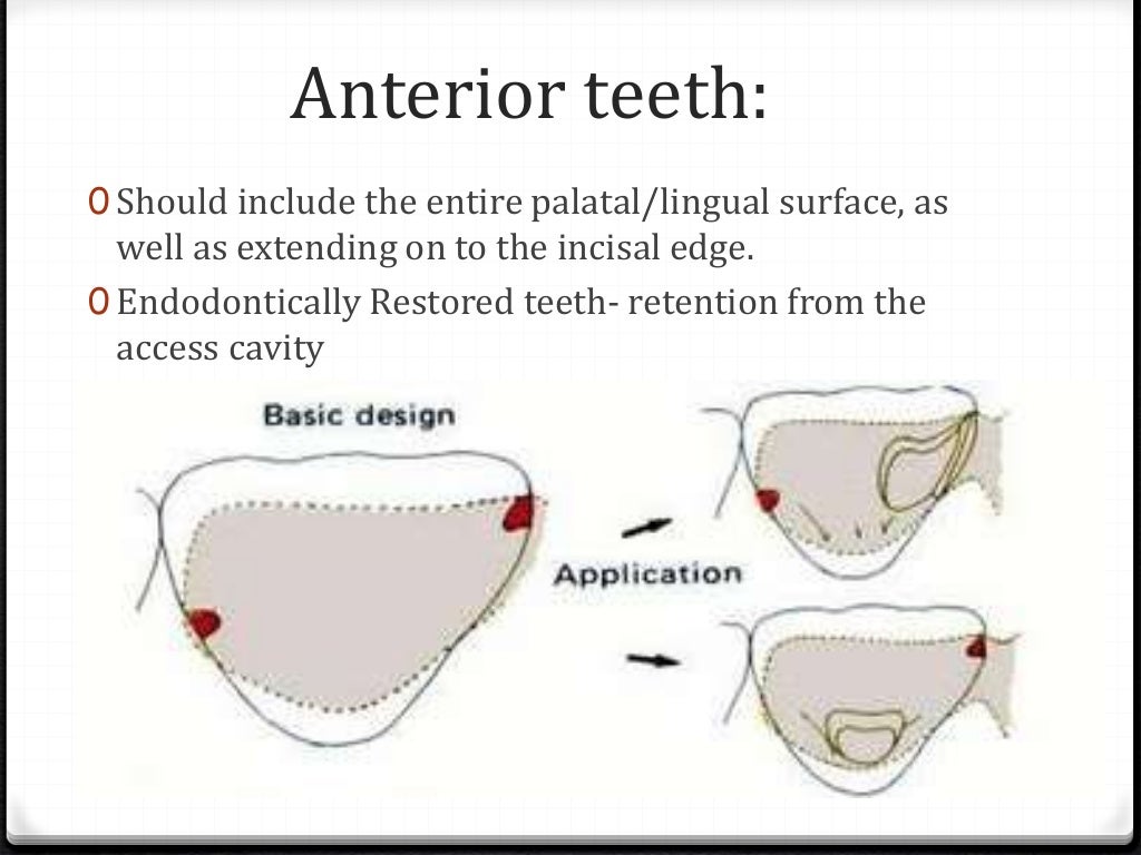Resin Bonded Bridges