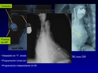 Electrodo de fijación activa en el tracto de salida del ventrículo derecho (TSVD) Abril 1999 Puertos de MP Conector Adaptador en “Y”, ánodo al TSVD y cátodo al VI. Programación inicial con retardo AV corto Programación independiente VI-VD TRC mas CDI Diciembre 2008 Electrodo en vena del seno coronario Electrodo en orejuela  derecha 