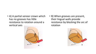 • A) A partial veneer crown which
has no grooves has little
resistance to rotation around a
vertical axis
• B) When groove...