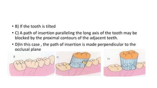 • B) If the tooth is tilted
• C) A path of insertion paralleling the long axis of the tooth may be
blocked by the proximal...