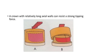 • A crown with relatively long axial walls can resist a strong tipping
force.
 
