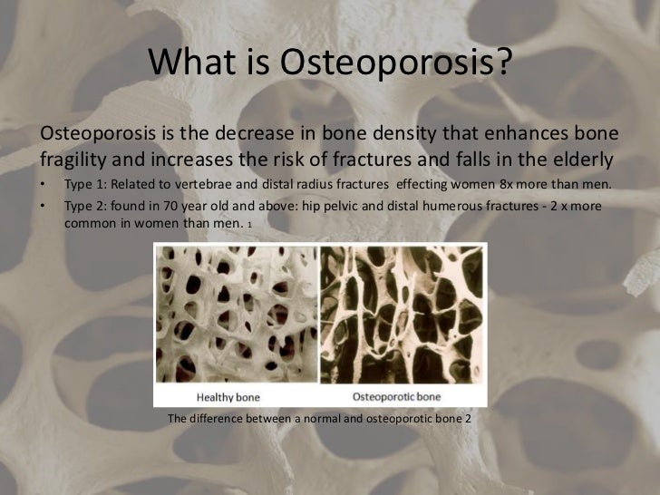 How Does Resistance Training Prevent Osteoporosis vrogue.co