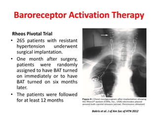 Baroreceptor Activation Therapy
Rheos Pivotal Trial
• 265 patients with resistant
hypertension underwent
surgical implantation.
• One month after surgery,
patients were randomly
assigned to have BAT turned
on immediately or to have
BAT turned on six months
later.
• The patients were followed
for at least 12 months
Bakris et al. J of Am Soc of HTN 2012
 