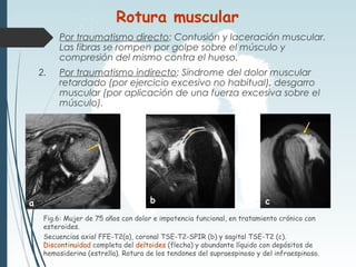 1. Por traumatismo directo: Contusión y laceración muscular.
Las fibras se rompen por golpe sobre el músculo y
compresión del mismo contra el hueso.
2. Por traumatismo indirecto: Síndrome del dolor muscular
retardado (por ejercicio excesivo no habitual), desgarro
muscular (por aplicación de una fuerza excesiva sobre el
músculo).
Fig.6: Mujer de 75 años con dolor e impotencia funcional, en tratamiento crónico con
esteroides.
Secuencias axial FFE-T2(a), coronal TSE-T2-SPIR (b) y sagital TSE-T2 (c).
Discontinuidad completa del deltoides (flecha) y abundante líquido con depósitos de
hemosiderina (estrella). Rotura de los tendones del supraespinoso y del infraespinoso.
Rotura muscular
a b c
*
 