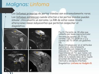  Los linfomas primarios de partes blandas son extremadamente raros.
 Los linfomas sistémicos cuando afectan a las partes blandas pueden
simular clínicamente un sarcoma. La RM de estos casos revela
alteraciones óseas subyacentes que permiten sospechar el
diagnóstico.
Fig.13: Paciente de 38 años que
consulta por masa supraclavicular.
Secuencias coronal SE-T1 (a),
coronal TSE-T2-SPIR (b y c) y
coronal SE-T1-SPIR con gadolinio
(d).
Masa intramuscular en el deltoides
(asterisco), discretamente
hiperintensa con respecto al
músculo en T1 y marcadamente
hiperintensa en T2, que realza con
gadolinio. Alteración extensa en la
señal de la médula ósea de la región
proximal del húmero, acromion,
clavícula y escápula (flechas).
Diagnóstico: Linfoma no Hodgkin B.
Malignas: Linfoma
a b
c d
* *
*
 
