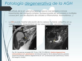 Patología degenerativa de la AGH
 La artrosis de la art. glenohumeral se asocia casi siempre a roturas
importantes del manguito rotador, aunque puede ser secundaria a múltiples
causas (enf. por de depósito de cristales o inflamatorias, traumatismos…)
 La RM puede mostrar elevación de la cabeza humeral, osteofitos en su
margen inferior, irregularidad de las tuberosidades, geodas y derrame
articular.
Fig. 20: Secuencias coronales SE-T1 (a) y TSE-T2-SPIR (b). Cambios degenerativos
evolucionados en art. glenohumeral con elevación superior de la cabeza humeral y grandes
osteofitos (flecha). Cambios degenerativos en art. acromioclavicular (asterisco) y rotura
del manguito rotador.
b
a
*
 