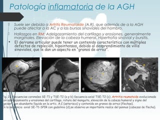 Patología inflamatoria de la AGH
 Suele ser debida a Artritis Reumatoide (A.R), que además de a la AGH
puede afectar a la AC y a las bursas sinoviales del hombro.
 Hallazgos en RM: Adelgazamiento del cartílago y erosiones, generalmente
marginales. Elevación de la cabeza humeral. Hipertrofia sinovial y bursitis.
 El derrame articular puede tener un contenido característico con múltiples
defectos de repleción, hipointensos, debido al desprendimiento de villis
sinoviales, que le dan un aspecto en “granos de arroz”.
Fig. 21: Secuencias coronales SE-T1 y TSE-T2 (a y b) Secuencia axial TSE-T2 (c) .Artritis reumatoide evolucionada
con adelgazamiento y erosiones del cartílago, rotura del manguito, elevación de la cabeza humeral y signo del
“geiser” con abundante líquido en la artic. A.C (asterisco) y contenido en granos de arroz (flechas).
En la secuencia axial SE-T1-SPIR con gadolinio (d),se observa un importante realce del pannus (cabezas de flecha).
a b c d
*
 