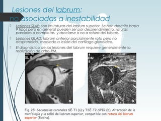 Lesiones del labrum:
no asociadas a inestabilidad
 Lesiones SLAP: son las roturas del labrum superior. Se han descrito hasta
9 tipos pero en general pueden ser por desprendimiento, roturas
parciales o completas, y asociarse o no a rotura del bíceps.
 Lesiones GLAD: labrum anterior parcialmente roto pero no
desprendido, asociado a lesión del cartílago glenoideo.
 El diagnóstico de las lesiones del labrum requiere generalmente la
realización de artro-RM.
Fig. 25: Secuencias coronales SE-T1 (a) y TSE-T2-SPIR (b). Alteración de la
morfología y la señal del labrum superior, compatible con rotura del labrum
superior (flecha).
a b
 
