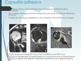 Capsulitis adhesiva
 Síndrome clínico caracterizado por dolor y gran limitación de la
movilidad.
 Secundario a engrosamiento de las estructuras de la cápsula articular y
sinovial.
 Puede ser de causa idiopática o secundaria a traumatismos o cirugía.
Fig.27: Secuencia coronales SE T1 (a) y TSE-T2-SPIR (b) y axial FFE-T2 (c).
Se aprecia engrosamiento de tejidos blandos en el receso axilar de la articulación (flecha
hueca) con aumento de la señal en T2 (flechas), característico de la capsulitis adhesiva.
a b
c
 