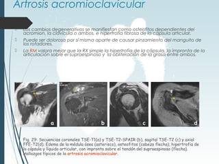 Artrosis acromioclavicular
 Los cambios degenerativos se manifiestan como osteofitos dependientes del
acromion, la clavícula o ambos, e hipertrofia fibrosa de la cápsula articular.
 Puede ser dolorosa por sí misma aparte de causar pinzamiento del manguito de
los rotadores.
 La RM valora mejor que la RX simple la hipertrofia de la cápsula, la impronta de la
articulación sobre el supraespinoso y la obliteración de la grasa entre ambos.
Fig. 29: Secuencias coronales TSE-T1(a) y TSE-T2-SPAIR (b), sagital TSE-T2 (c) y axial
FFE-T2(d). Edema de la médula ósea (asterisco), osteofitos (cabeza flecha), hipertrofia de
la cápsula y líquido articular, con impronta sobre el tendón del supraespinoso (flecha).
Hallazgos típicos de la artrosis acromioclavicular.
a b c d
*
 