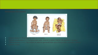 Valoración del edema
 Edema leve(+): Se presenta solo en los pies.
 Edema moderado(++): Compromete pies, manos y parte inferior de piernas y brazos.
 Edema severo (+++): Se refiere al edema generalizado que incluye pies, piernas, manos,
 brazos y cara.
 