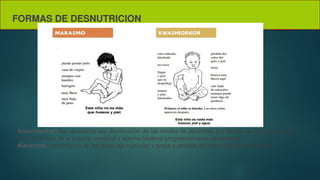 FORMAS DE DESNUTRICION
Kwashiorkor: Se caracteriza por disminución de los niveles de albúmina, por debajo de 2.5 g/dl, que lo
lleva a pérdida de la presión oncótica y edema bilateral progresivamente ascendente..
Marasmo. agotamiento de las reservas muscular y grasa y pérdida de tejido celular subcutáneo
 