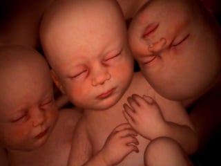 Resolucion embarazo gemelar.mony