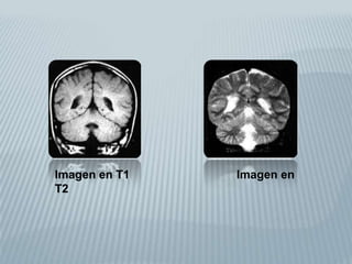 Los núcleos (con los más abundantes son los de H en el organismo humano) son capaces de aceptar y emitir energía (resuenan) al ser sometidos a la acción de las ondas de RF