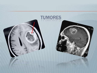 SNC y Medula Espinal