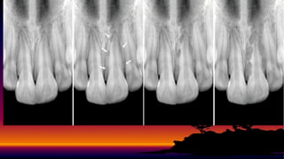 resorption ,Present status and future directions : Root resorption | PPTX