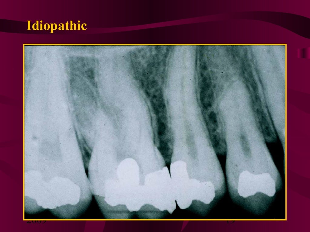 Teeth Resorption