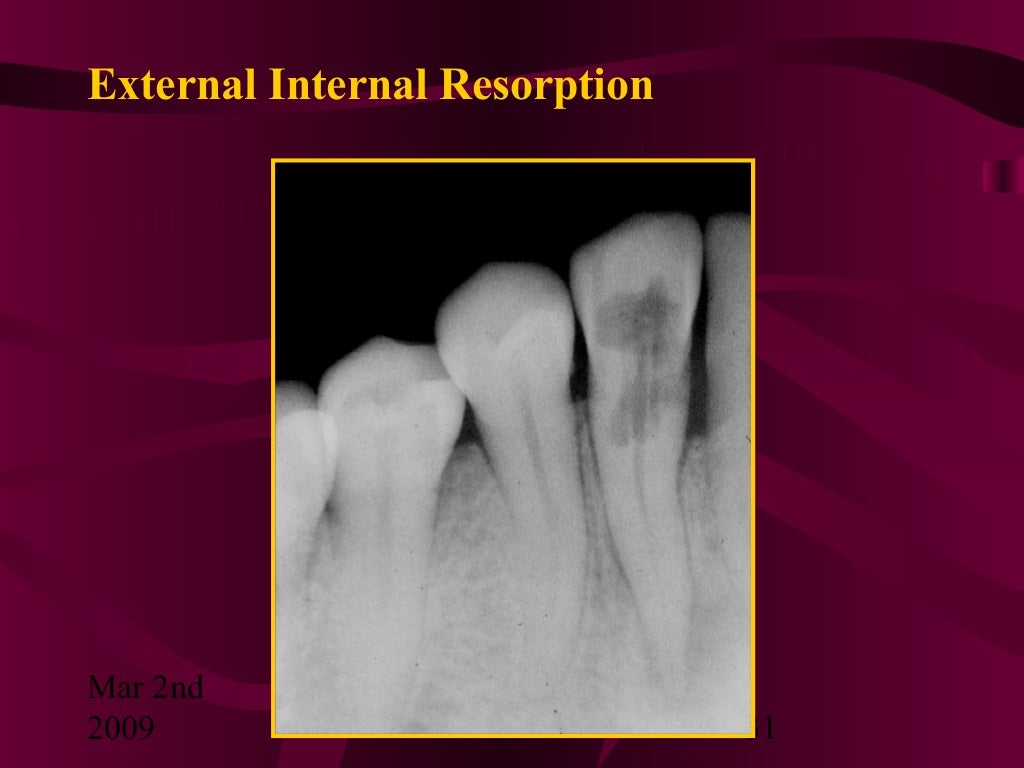 Teeth Resorption
