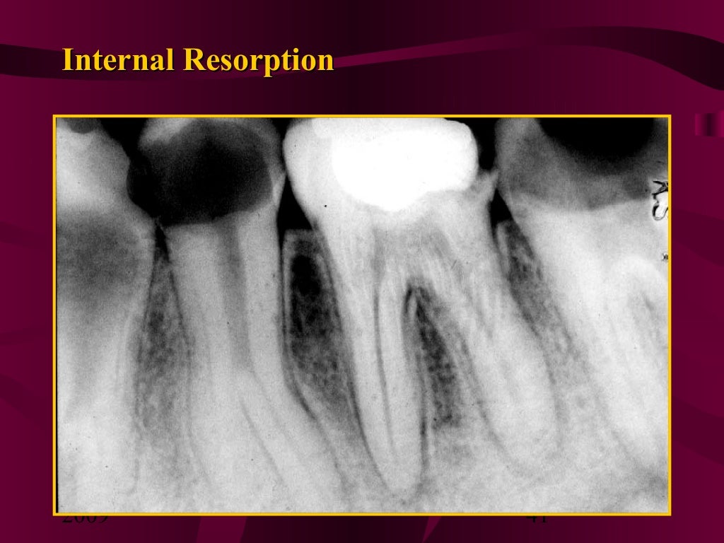 Teeth Resorption