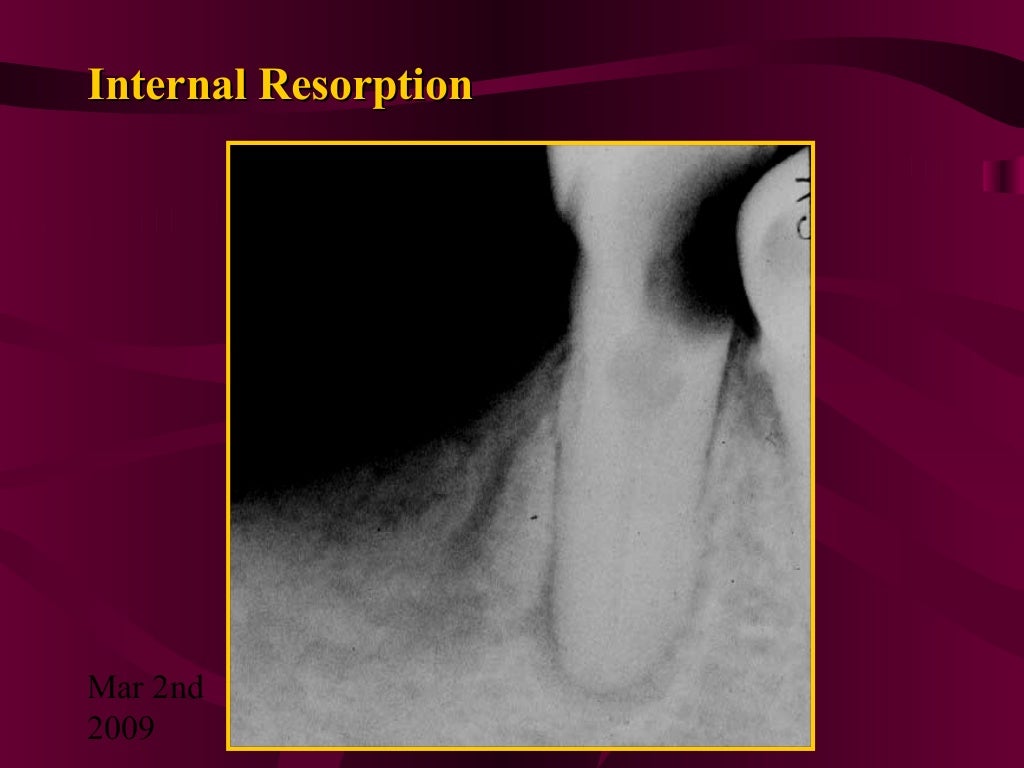 Teeth Resorption