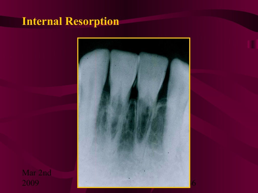 Teeth Resorption