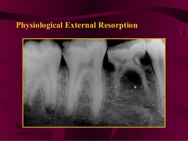 Teeth Resorption