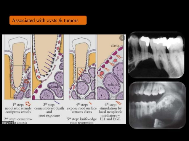 Resorption of teeth | PPTX