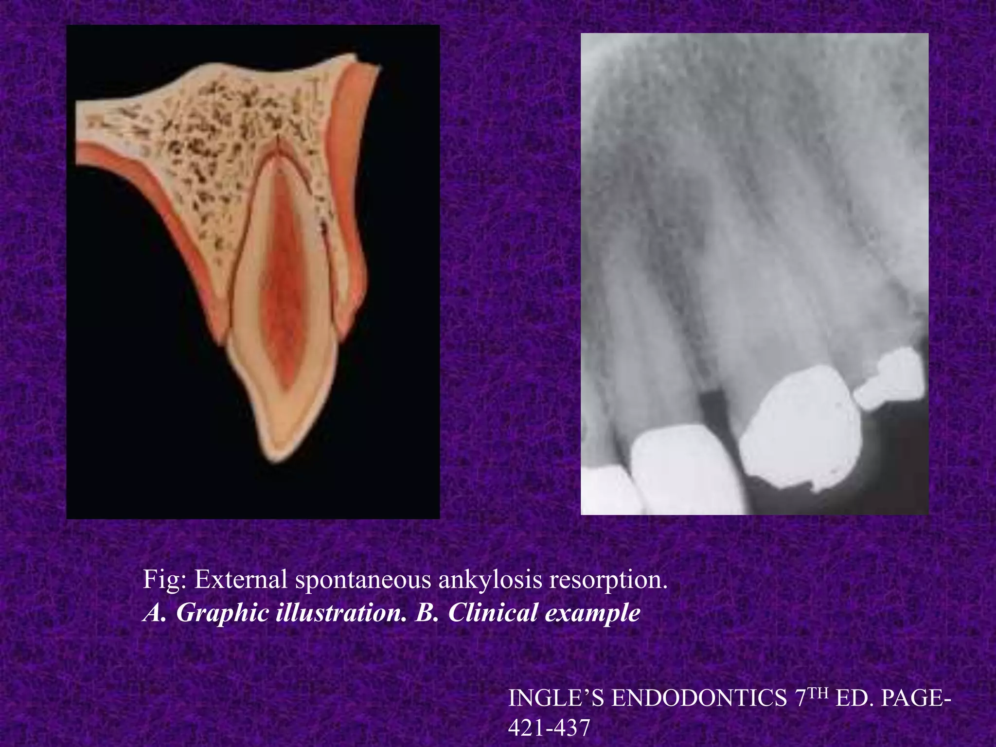 Fig: External spontaneous ankylosis resorption.
A. Graphic illustration. B. Clinical example
INGLE’S ENDODONTICS 7TH ED. PAGE-
421-437
 