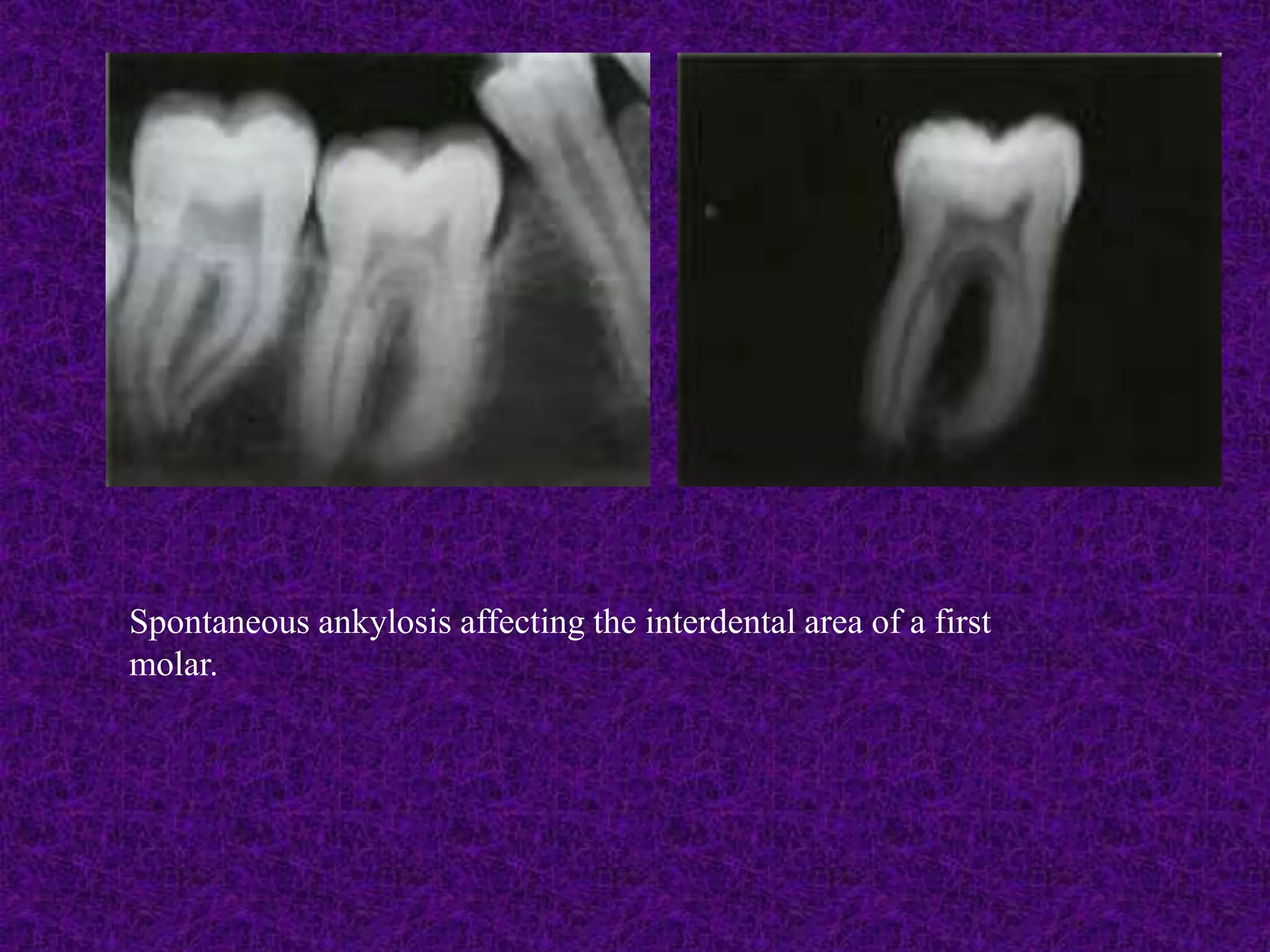 Spontaneous ankylosis affecting the interdental area of a first
molar.
 