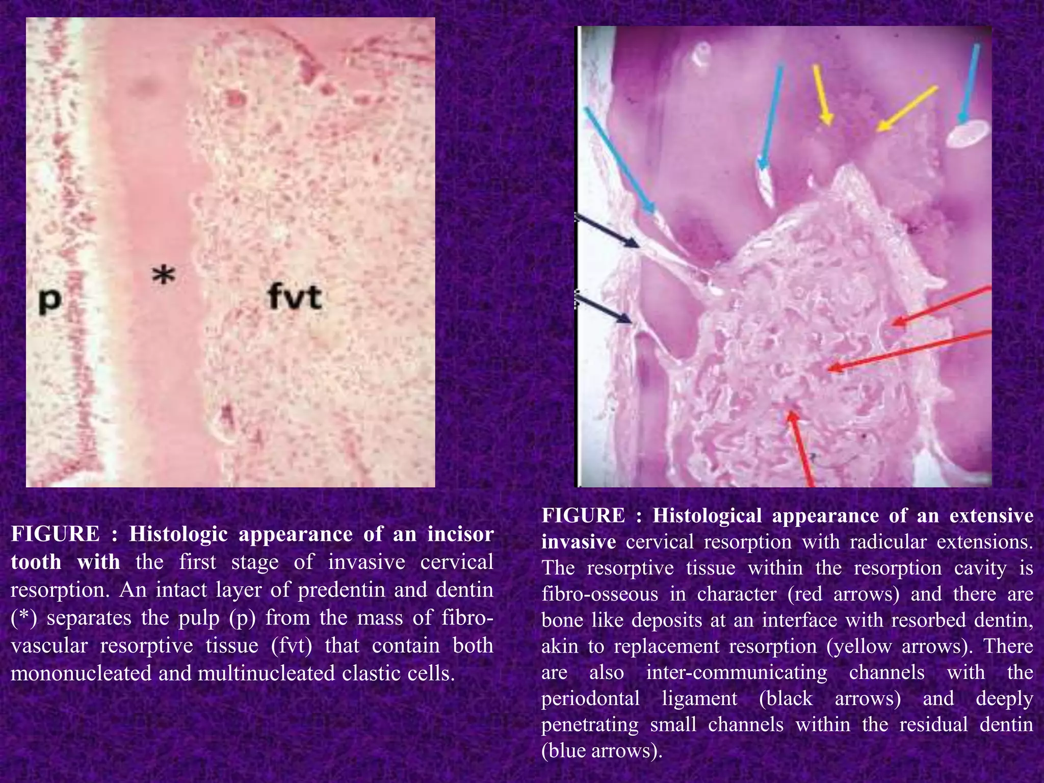 FIGURE : Histologic appearance of an incisor
tooth with the first stage of invasive cervical
resorption. An intact layer of predentin and dentin
(*) separates the pulp (p) from the mass of fibro-
vascular resorptive tissue (fvt) that contain both
mononucleated and multinucleated clastic cells.
FIGURE : Histological appearance of an extensive
invasive cervical resorption with radicular extensions.
The resorptive tissue within the resorption cavity is
fibro-osseous in character (red arrows) and there are
bone like deposits at an interface with resorbed dentin,
akin to replacement resorption (yellow arrows). There
are also inter-communicating channels with the
periodontal ligament (black arrows) and deeply
penetrating small channels within the residual dentin
(blue arrows).
 
