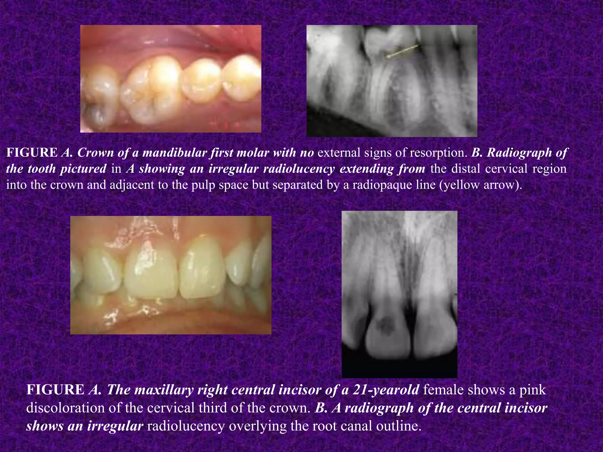 FIGURE A. Crown of a mandibular first molar with no external signs of resorption. B. Radiograph of
the tooth pictured in A showing an irregular radiolucency extending from the distal cervical region
into the crown and adjacent to the pulp space but separated by a radiopaque line (yellow arrow).
FIGURE A. The maxillary right central incisor of a 21-yearold female shows a pink
discoloration of the cervical third of the crown. B. A radiograph of the central incisor
shows an irregular radiolucency overlying the root canal outline.
 
