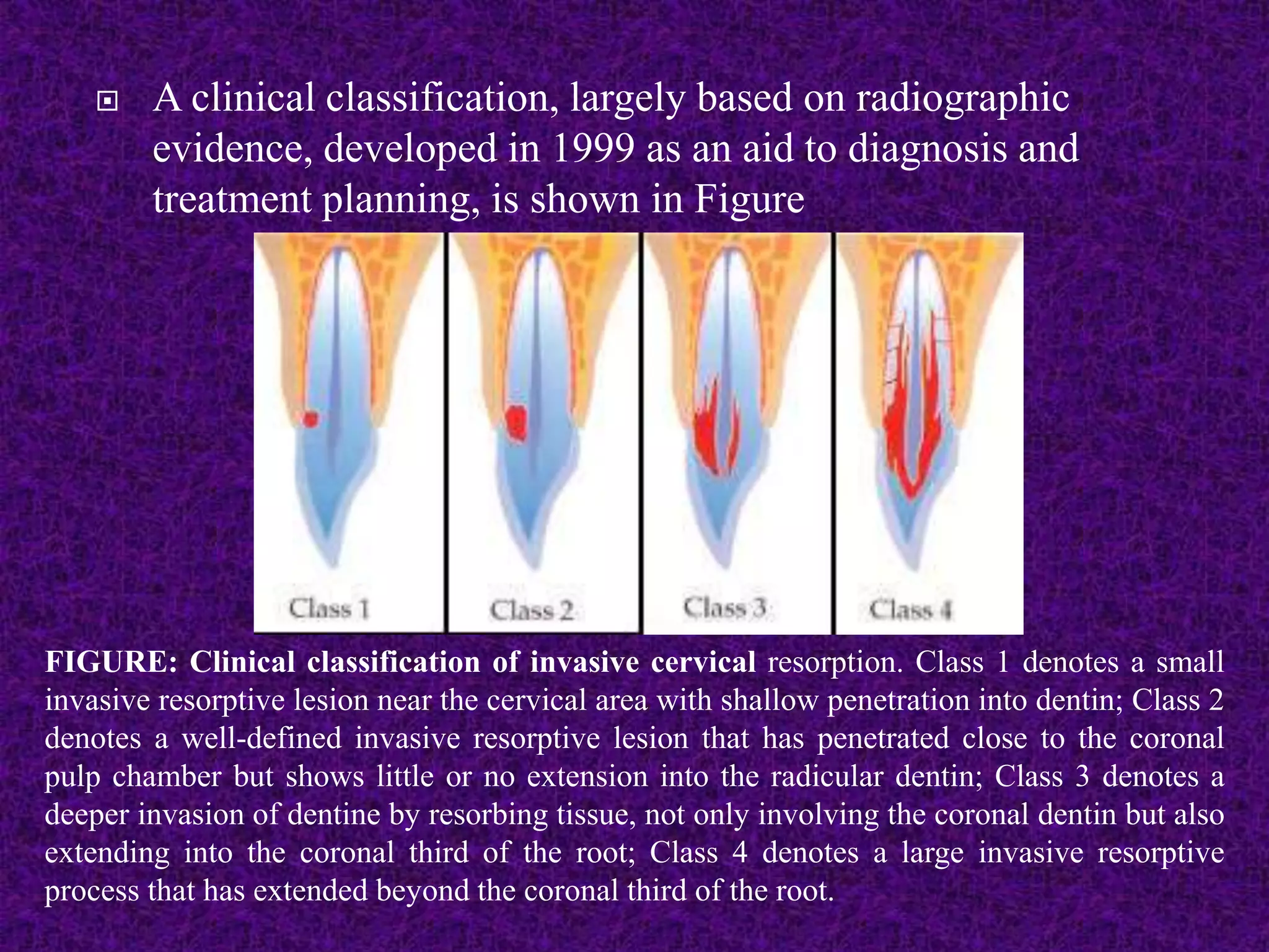  A clinical classification, largely based on radiographic
evidence, developed in 1999 as an aid to diagnosis and
treatment planning, is shown in Figure
FIGURE: Clinical classification of invasive cervical resorption. Class 1 denotes a small
invasive resorptive lesion near the cervical area with shallow penetration into dentin; Class 2
denotes a well-defined invasive resorptive lesion that has penetrated close to the coronal
pulp chamber but shows little or no extension into the radicular dentin; Class 3 denotes a
deeper invasion of dentine by resorbing tissue, not only involving the coronal dentin but also
extending into the coronal third of the root; Class 4 denotes a large invasive resorptive
process that has extended beyond the coronal third of the root.
 