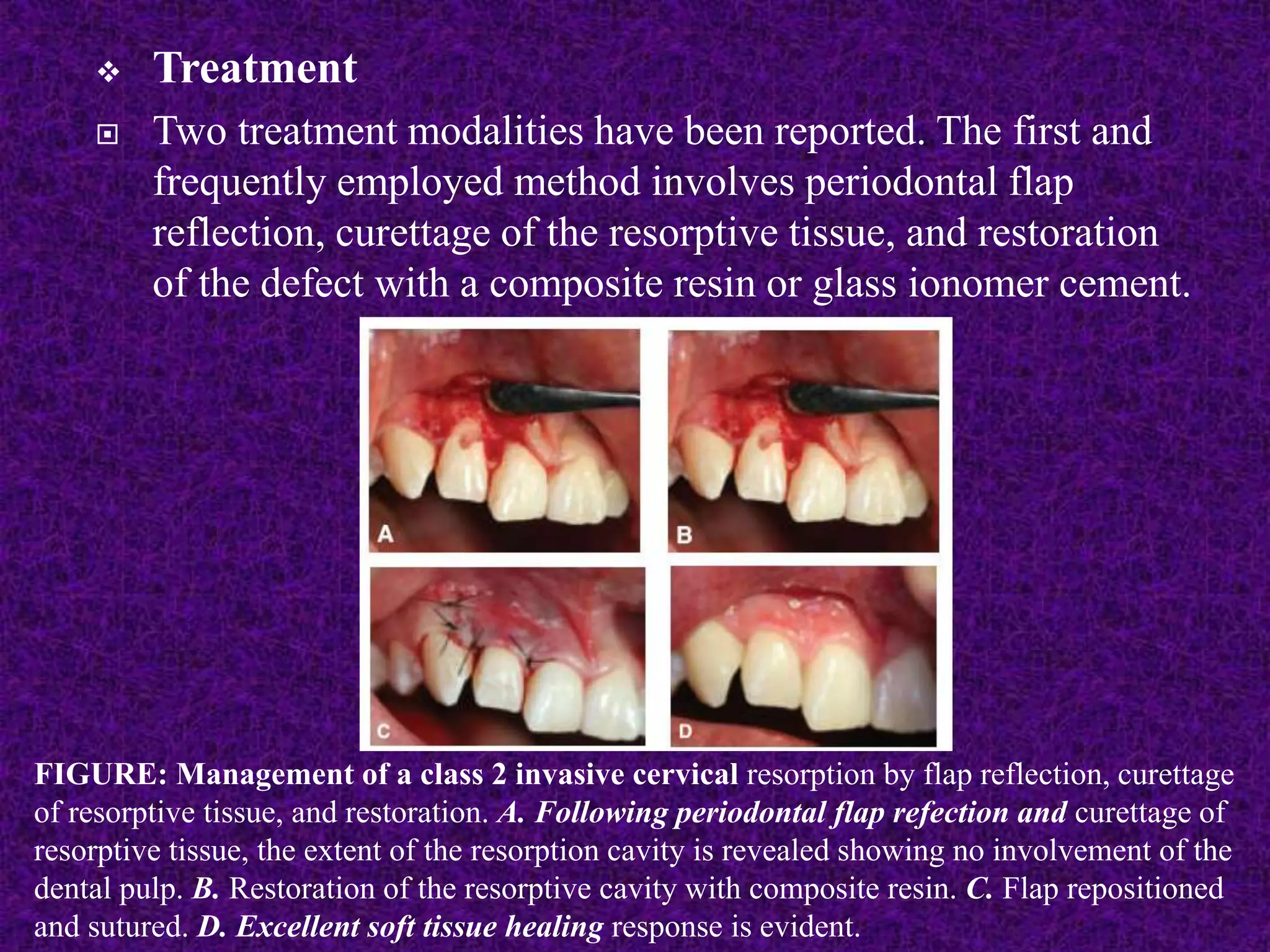  Treatment
 Two treatment modalities have been reported. The first and
frequently employed method involves periodontal flap
reflection, curettage of the resorptive tissue, and restoration
of the defect with a composite resin or glass ionomer cement.
FIGURE: Management of a class 2 invasive cervical resorption by flap reflection, curettage
of resorptive tissue, and restoration. A. Following periodontal flap refection and curettage of
resorptive tissue, the extent of the resorption cavity is revealed showing no involvement of the
dental pulp. B. Restoration of the resorptive cavity with composite resin. C. Flap repositioned
and sutured. D. Excellent soft tissue healing response is evident.
 