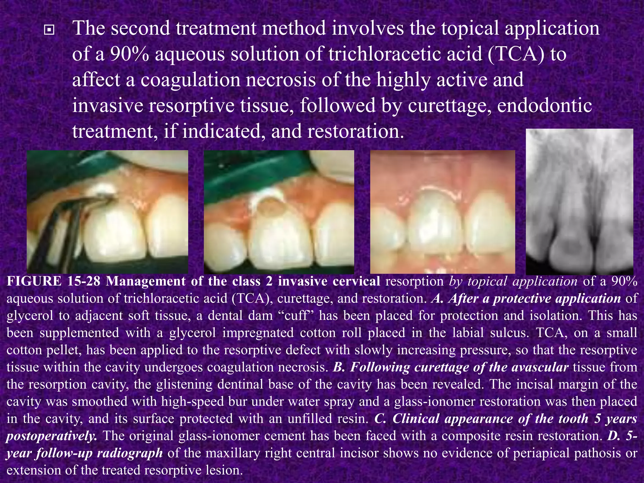  The second treatment method involves the topical application
of a 90% aqueous solution of trichloracetic acid (TCA) to
affect a coagulation necrosis of the highly active and
invasive resorptive tissue, followed by curettage, endodontic
treatment, if indicated, and restoration.
FIGURE 15-28 Management of the class 2 invasive cervical resorption by topical application of a 90%
aqueous solution of trichloracetic acid (TCA), curettage, and restoration. A. After a protective application of
glycerol to adjacent soft tissue, a dental dam “cuff” has been placed for protection and isolation. This has
been supplemented with a glycerol impregnated cotton roll placed in the labial sulcus. TCA, on a small
cotton pellet, has been applied to the resorptive defect with slowly increasing pressure, so that the resorptive
tissue within the cavity undergoes coagulation necrosis. B. Following curettage of the avascular tissue from
the resorption cavity, the glistening dentinal base of the cavity has been revealed. The incisal margin of the
cavity was smoothed with high-speed bur under water spray and a glass-ionomer restoration was then placed
in the cavity, and its surface protected with an unfilled resin. C. Clinical appearance of the tooth 5 years
postoperatively. The original glass-ionomer cement has been faced with a composite resin restoration. D. 5-
year follow-up radiograph of the maxillary right central incisor shows no evidence of periapical pathosis or
extension of the treated resorptive lesion.
 