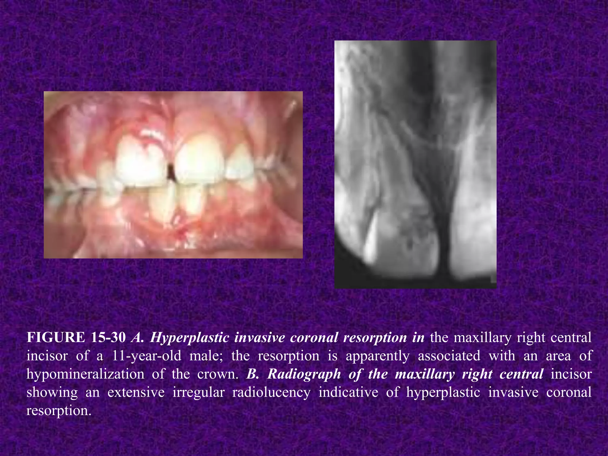 FIGURE 15-30 A. Hyperplastic invasive coronal resorption in the maxillary right central
incisor of a 11-year-old male; the resorption is apparently associated with an area of
hypomineralization of the crown. B. Radiograph of the maxillary right central incisor
showing an extensive irregular radiolucency indicative of hyperplastic invasive coronal
resorption.
 