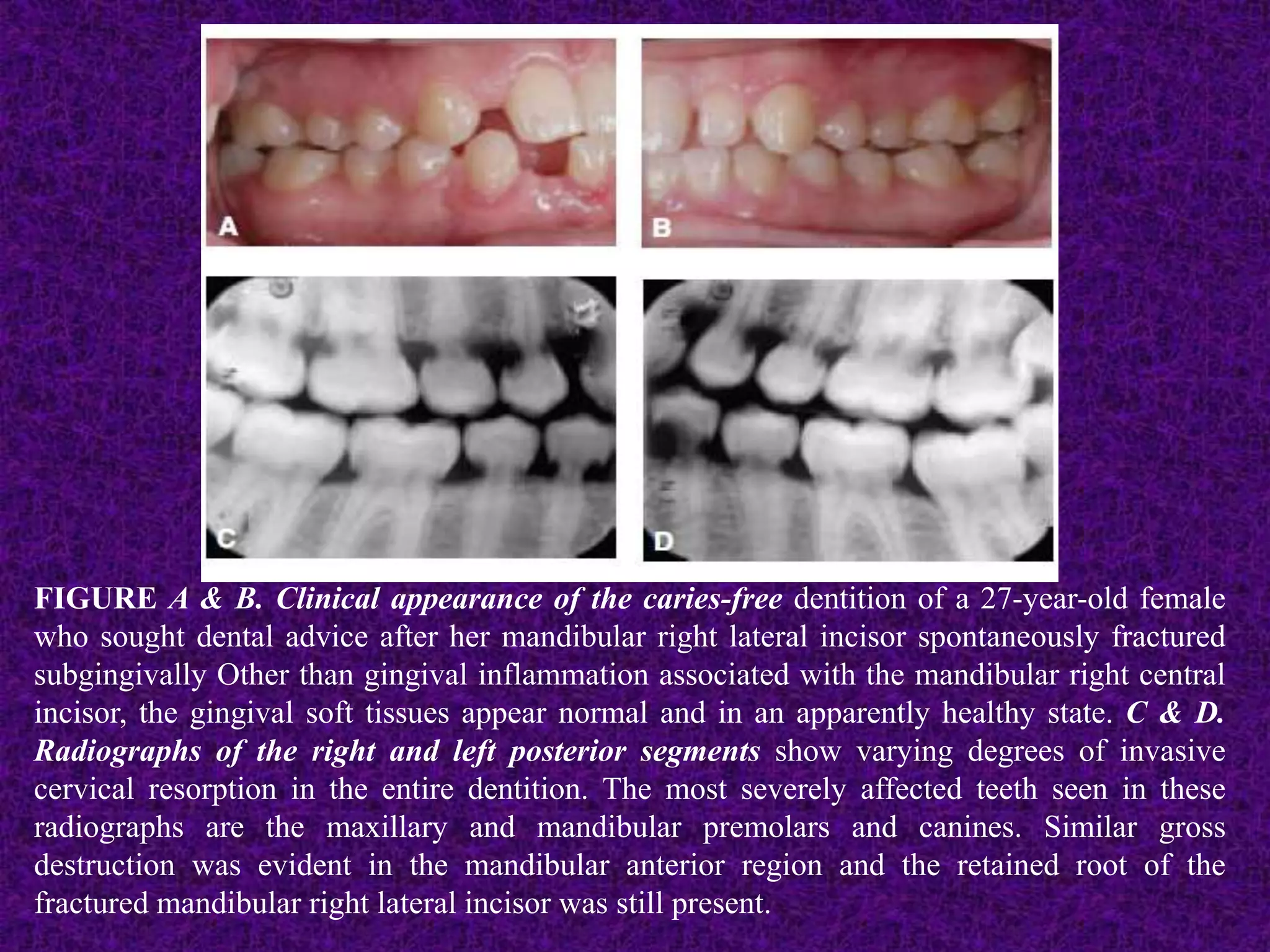 FIGURE A & B. Clinical appearance of the caries-free dentition of a 27-year-old female
who sought dental advice after her mandibular right lateral incisor spontaneously fractured
subgingivally Other than gingival inflammation associated with the mandibular right central
incisor, the gingival soft tissues appear normal and in an apparently healthy state. C & D.
Radiographs of the right and left posterior segments show varying degrees of invasive
cervical resorption in the entire dentition. The most severely affected teeth seen in these
radiographs are the maxillary and mandibular premolars and canines. Similar gross
destruction was evident in the mandibular anterior region and the retained root of the
fractured mandibular right lateral incisor was still present.
 