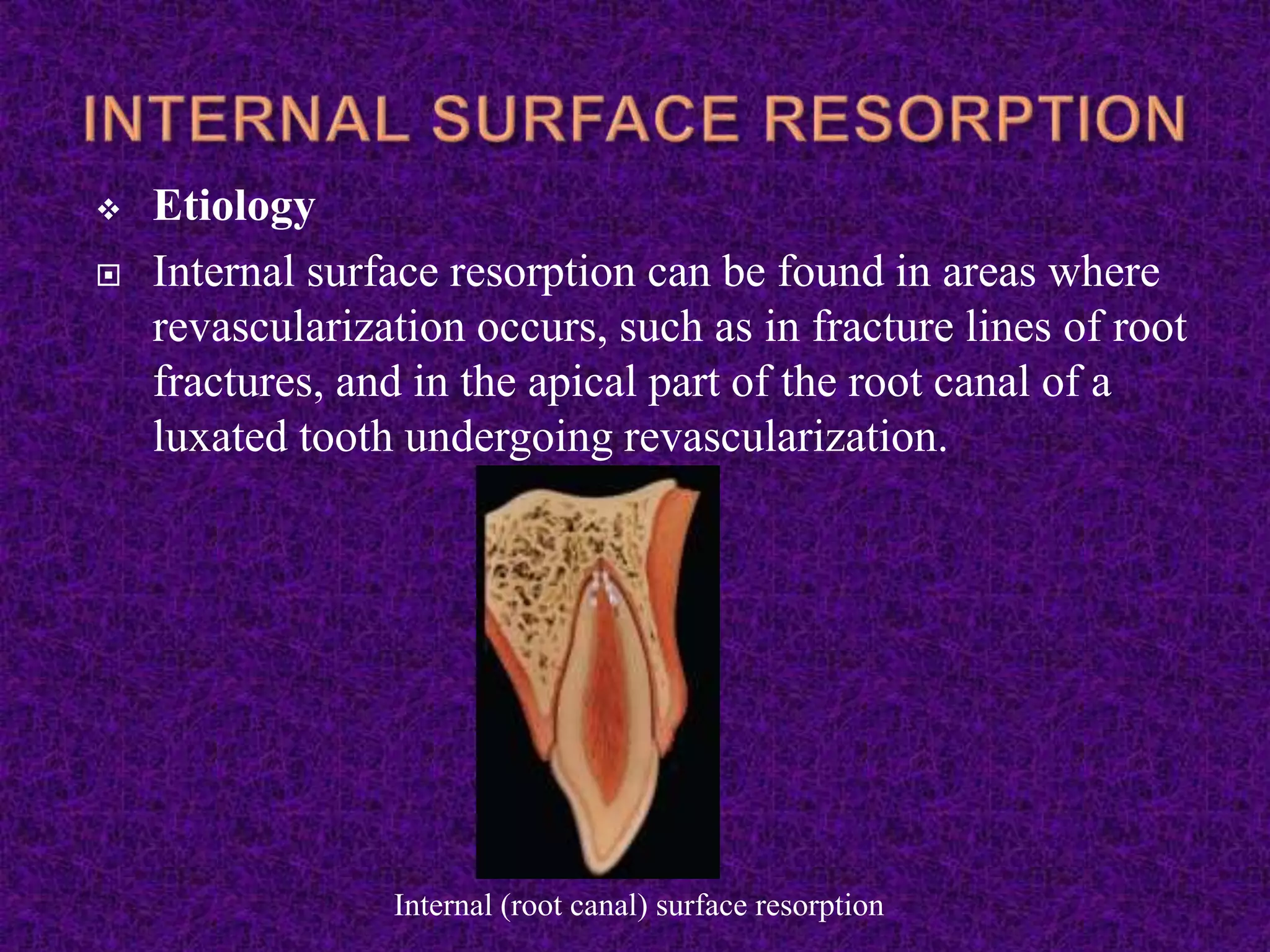  Etiology
 Internal surface resorption can be found in areas where
revascularization occurs, such as in fracture lines of root
fractures, and in the apical part of the root canal of a
luxated tooth undergoing revascularization.
Internal (root canal) surface resorption
 