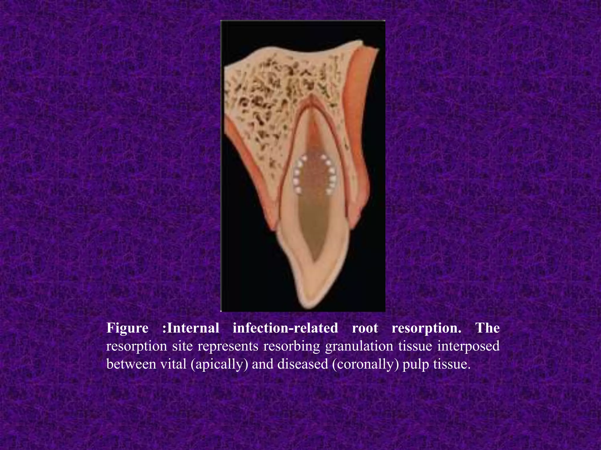Figure :Internal infection-related root resorption. The
resorption site represents resorbing granulation tissue interposed
between vital (apically) and diseased (coronally) pulp tissue.
 
