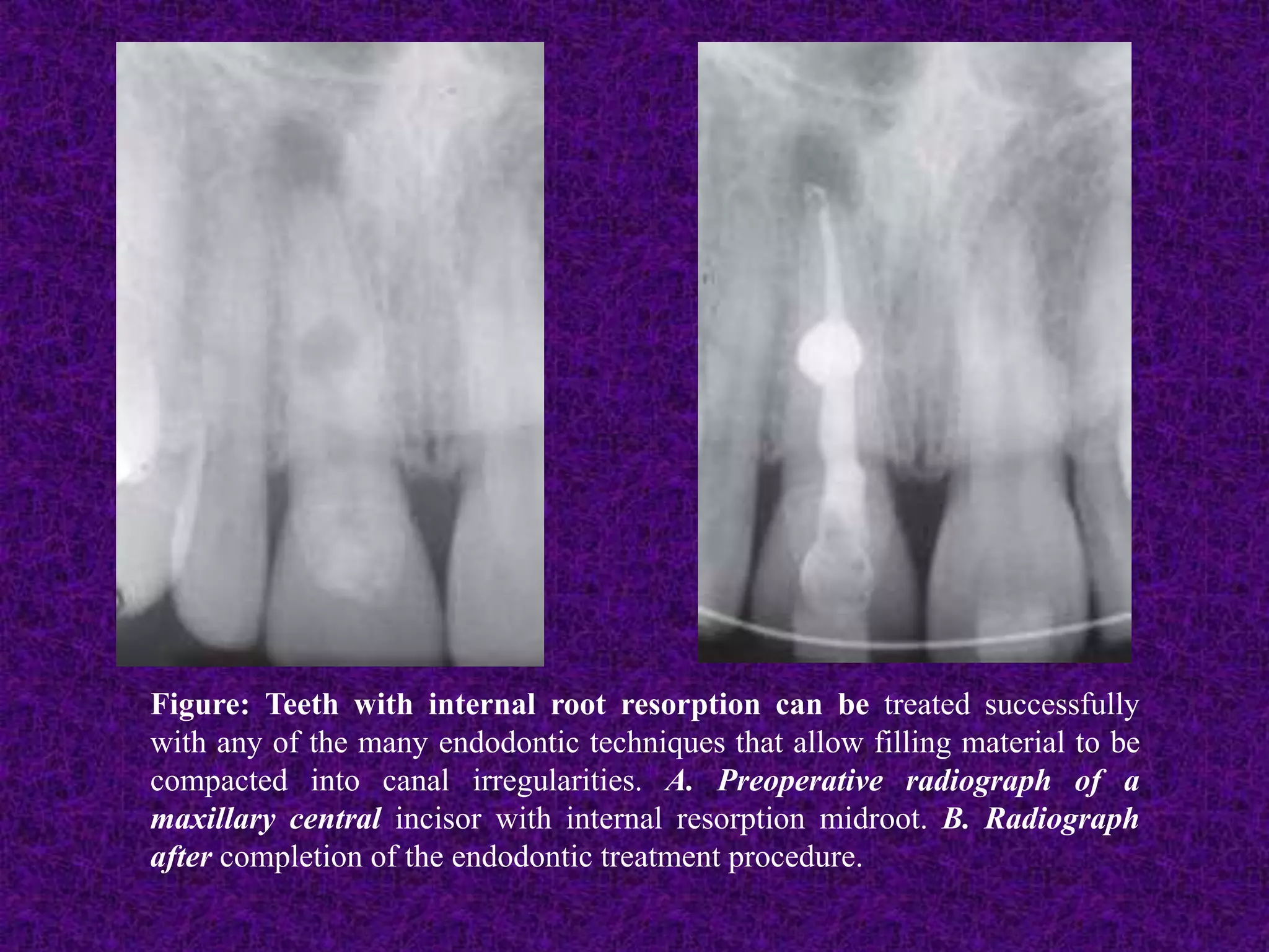 Figure: Teeth with internal root resorption can be treated successfully
with any of the many endodontic techniques that allow filling material to be
compacted into canal irregularities. A. Preoperative radiograph of a
maxillary central incisor with internal resorption midroot. B. Radiograph
after completion of the endodontic treatment procedure.
 